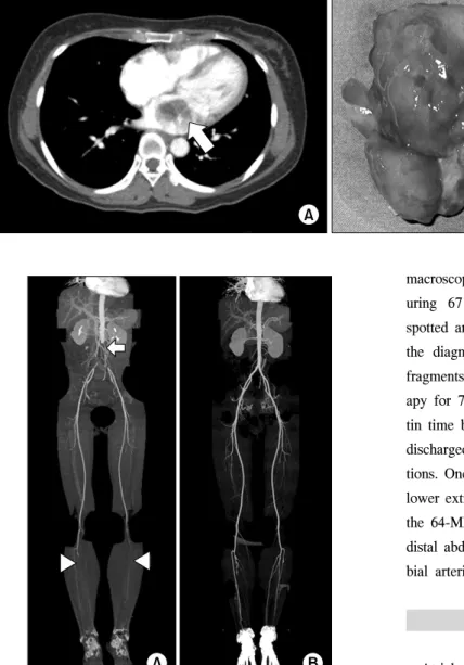 Fig. 1. (A) Conventional chest com- com-puted tomography scan revealed a  slow attenuation mass lesion in the  left atrium (arrow)