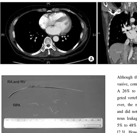 Fig. 2. Polymethylmethacrylate segments from the right atrium  (RA), right ventricle (RV), and right pulmonary artery (RPA)