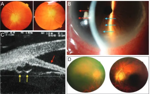 Fig. 1. (A) 2004 Fundoscopy showing bilateral blurred optic disc margins, vessel sclerosis, and normal macula