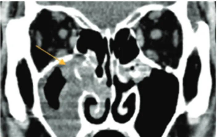 Fig. 5. A 47-year-old male patient with epiphora, swelling, and  pain in right eye. The computed tomography image in the coronal  plane shows severe right ethmoditis and maxillary sinusitis  (ar-row).