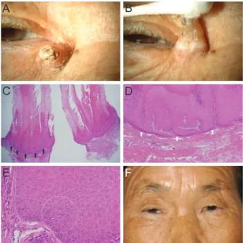 Fig. 1. (A) External clinical photographs of the presenting patient  showing a 5 × 5-mm-sized mass consisting of a dome-shaped  base, horn-shaped top and hyperkeratinized tip in the right  medial canthal area