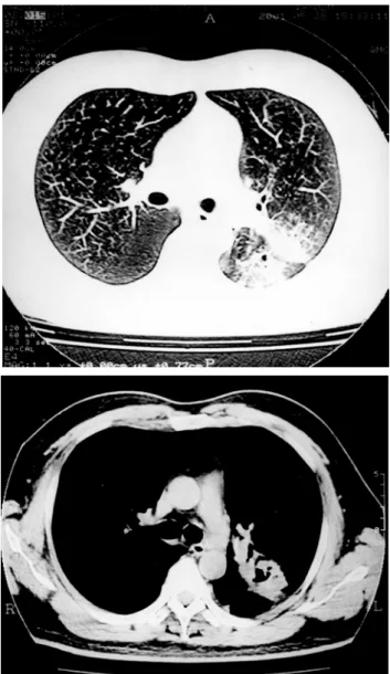 Fig.  2.  Computed  tomographic  finding  of  the  chest  showing  air  bronchogram  and  multifocal  cavity.
