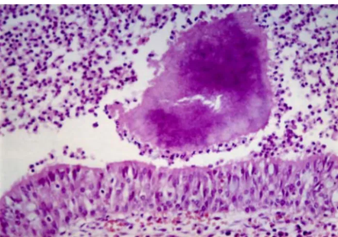 Fig.  3.  A  typical  sulfur  granule  in  bronchial  lumen  surrounded  by  acute  and  chronic  inflammatory  cells(H  &amp;  E,  X  400).