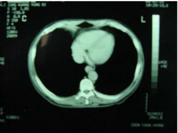 Fig.  3.  EUS  showing  lobulated  mass  intermediate  echoic  pattern  and  multiple  small  anechoic  lesion.
