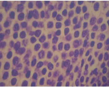 Fig.  5.  Proliferating  lymphoid  cells  are  centrocyte-like  in  appearance  and  have  central  nuclei  with  irregular  nuclear  membrane  and  abundant  clear  cytoplasm.(H  &amp;  E  stain,  ×1000)
