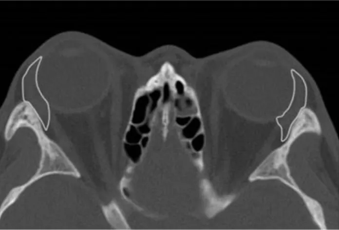 Fig. 1. Axial computed tomography scan viewed on the DICOM  viewer (OsiriX, Geneva, Switzerland) with the entire lacrimal  gland outlined.