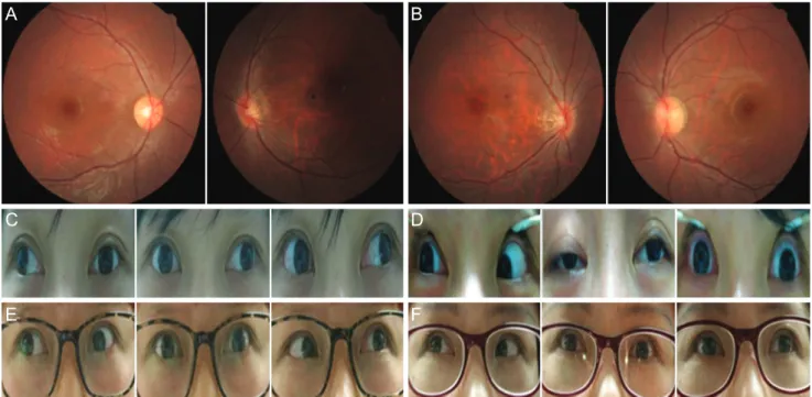 Fig. 1. Fundus photographs showing the mirror-image myopic tilted disc, tigroid fundus, and reduction of foveal reflex in the left eye of  twin 1 (A) and in the right eye of twin 2 (B), which is consistent with mirror-image amblyopia due to myopic anisomet