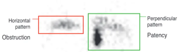 Fig. 1. Patency pattern of dacryoscintigraphic findings.