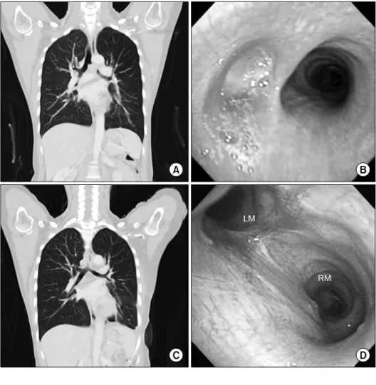 Fig. 1. (A) Preoperative chest com- com-puted tomography (CT) scan shows  an endobronchial mass obstructing  the left main bronchus, and  extra-luminally invading subcarinal area