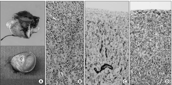 Fig. 3. (A) Gross finding of resected endobronchial mass. (B) Microscopic findings showing abundant spindle cells and inflammatory cells  (H&amp;E, ×200)