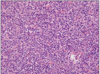 Fig. 2. Postoperative pathology slide shows the thymoma (H&amp;E  stain, ×200, Type A＋B2).