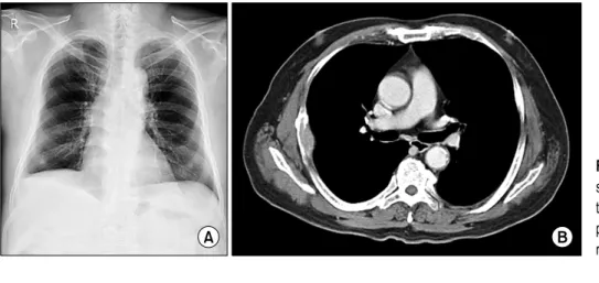 Fig. 1. (A) Simple chest X-ray  showing pleural thickening around  the right 5th rib. (B) Chest  com-puted tomography scan demonstrates  rib tumor with osteolytic lesion.