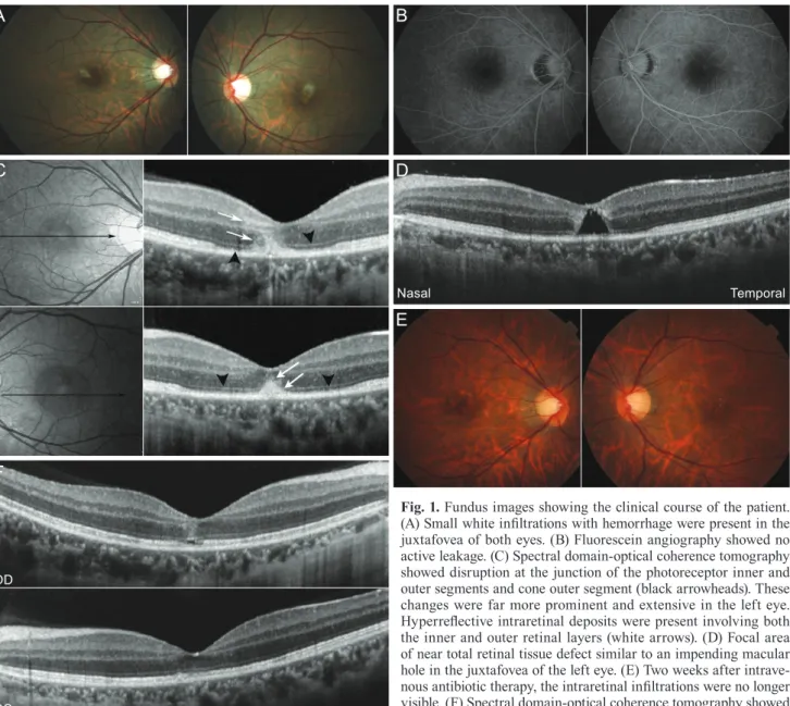 Fig. 1. Fundus images showing the clinical course of the patient. 