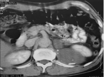 Fig.  2.  Abdomen  CT  scan  1 Fig.  4.  Operative  finding