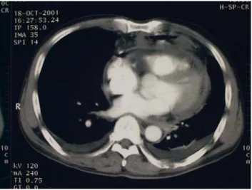 Fig.  4.  Operation  field  view,  large  ulcer  based  defect(arrow),  communicating  pedicled  stomach  and  pericardial  sac.