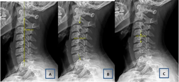 Table 1. Values of Cervical Alignment before and after MFR. 