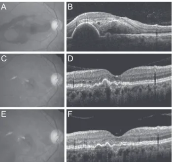 Fig. 2. Changes in the mean logarithm of minimal angle of res- res-olution (logMAR) best-corrected visual acuity (BCVA) among  eyes that received anti-vascular endothelial growth factor  mono-therapy for submacular hemorrhage secondary to exudative  age-re