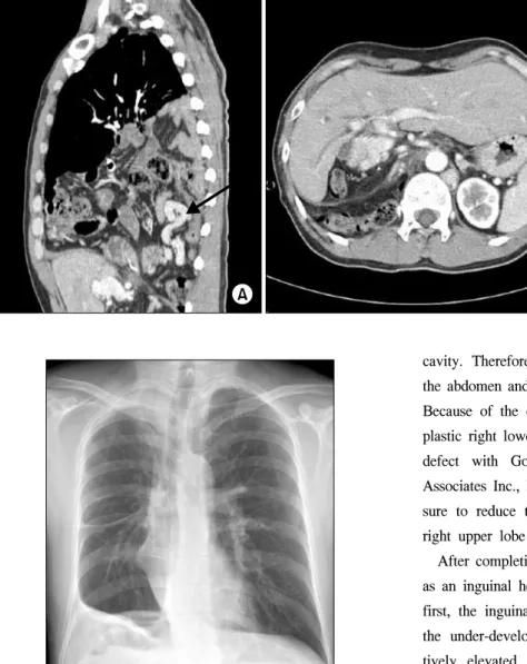 Fig. 2. (A) The upper computed to- to-mography scan shows herniation of  various abdominal organs with  en-gorged mesenteric vein (arrow)