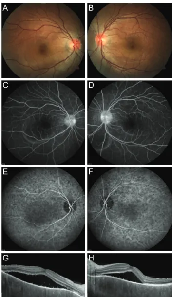 Fig. 2. Representative case of acute bilateral central serous cho- cho-rioretinopathy