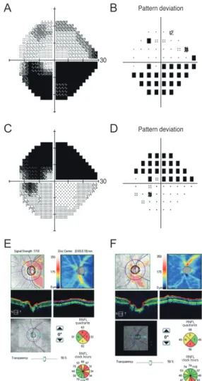 Fig. 1. The results of visual field test (A-D) and spectral domain  optical coherence (E,F)