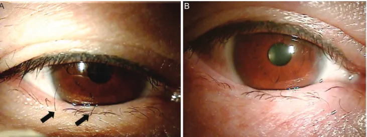 Fig. 2. (A) An image of the preoperative eyelashes (black arrows). (B) An image of eyelashes six months after the operation.