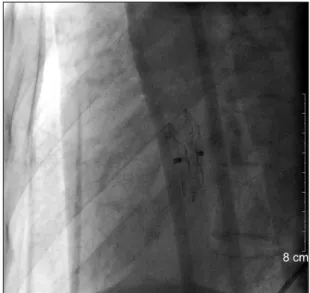 Fig. 3. Follow-up echocardiography performed the day after percu- percu-taneous transcatheter septal closure