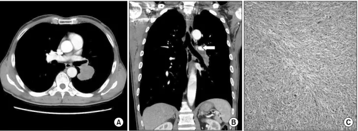 Fig. 1. Computed tomography scan of chest shows (A) about 5×4 cm lobulated mass arising superior segmental bronchus in lower lobe  with (B) interlobar pulmonary artery invasion (arrow)