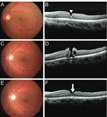 Fig. 3. (A,B) Fundus photograph and spectral domain-optical  coherence tomography (SD-OCT) images after the initial pars  plana vitrectomy