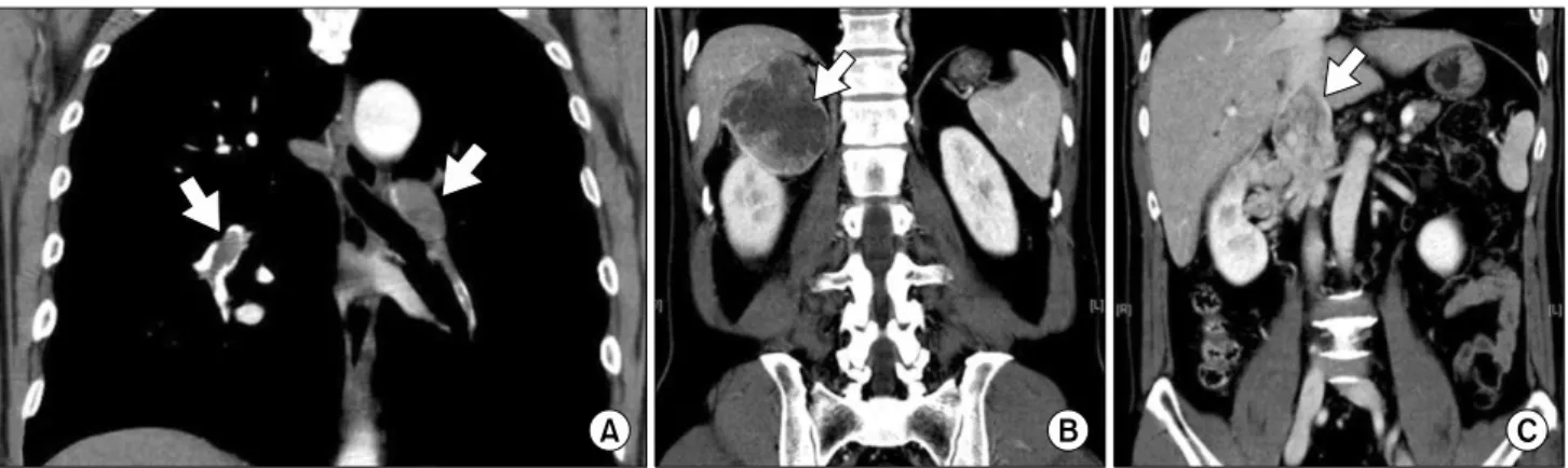 Fig. 1. (A) Chest computed tomography shows filling defects in the pulmonary arteries, characteristic of pulmonary embolism
