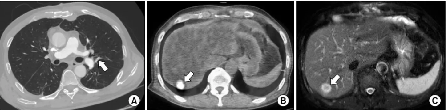 Fig. 3. (A) Tiny remnant remained in the left lower lobe posterobasal segmental pulmonary artery