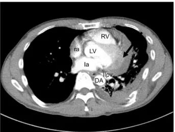 Fig. 2. Preoperative chest computed tomography scan showed left  rib fractures, hemothorax, and blood collection around left side of  heart compressing ventricles (arrow)