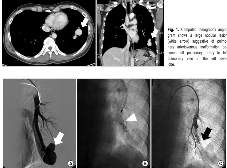 Fig. 1. Computed tomography angio- angio-gram shows a large nodular lesion  (white arrow) suggestive of  pulmo-nary arteriovenous malformation  be-tween left pulmonary artery to left  pulmonary vein in the left lower  lobe.
