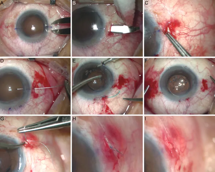 Fig. 1. Sutureless intrascleral pocket technique for transscleral fixation of intraocular lens (IOL)