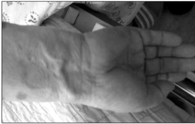 Fig. 1. Dilated superficial veins over right wrist.