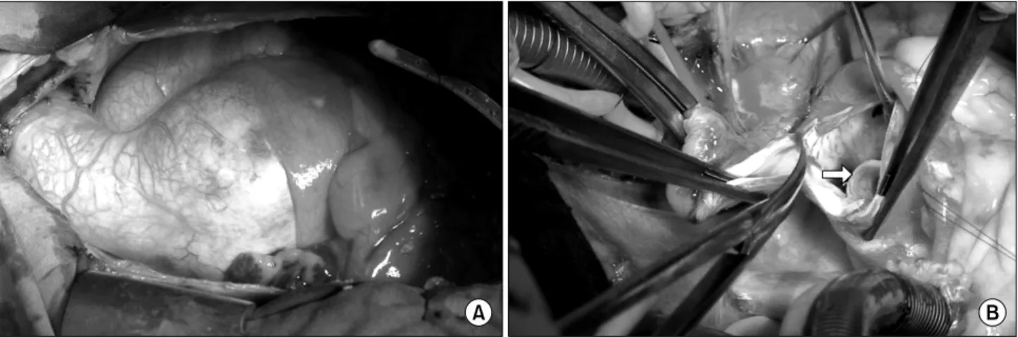 Fig. 2. Intraoperative gross findings. (A) A huge aortic ectasia was noted, aortic cross-clamping was performed, and the aneurysm sac  was opened