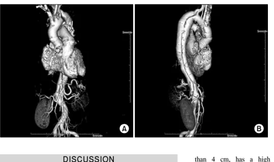 Fig. 3. Follow-up 3-dimensional com- com-puted tomography angiogram. (A)  Normal ascending aorta (after the  Bentall operation)