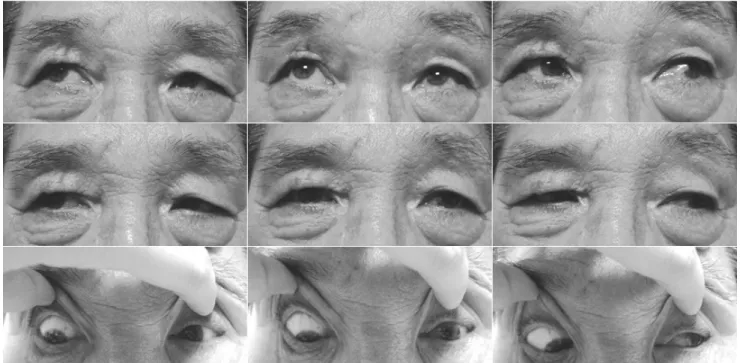 Fig. 1. A limitation of depression was found in adduction, primary gaze and abduction in the left eye.