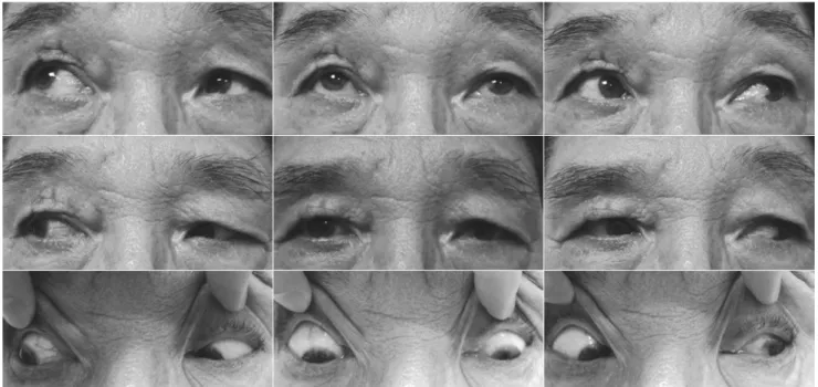 Fig. 3. Three weeks after oral steroid medication administration, the limitation of depression was completely resolved.