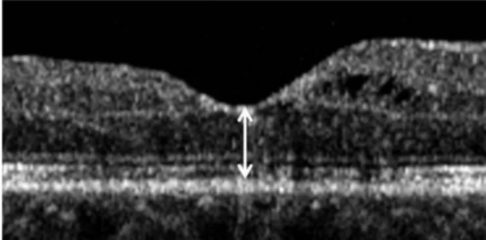 Fig. 1. Central foveal thickness (arrow) was defined as the vertical  distance between the internal limiting membrane and the retinal  pigment epithelium at the foveal center, based on optical  coher-ence tomography imaging centered at the center of the fo