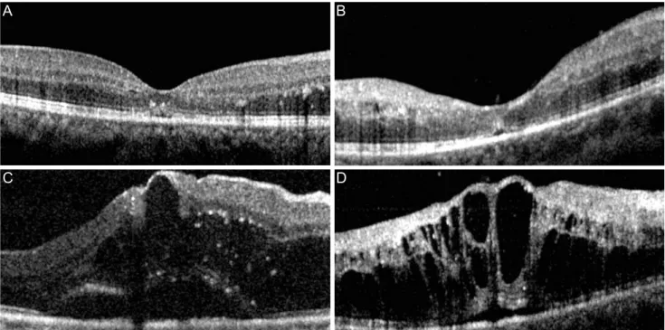 Fig. 3. Optical coherence tomography findings before (A,B) and after (C,D) recurrence of macular edema in 2 patients with retinal vein  occlusion who did not recognize a reduction in visual acuity
