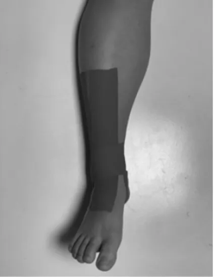 Fig. 3. Joint stabilization taping.
