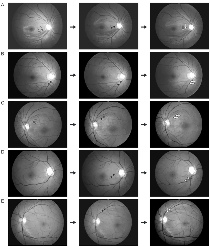 Fig. 1 .  Red-free fundus photographs show patterns of continuous progression of localized retinal nerve fiber layer defects such as  (A) continuous widening (arrow heads and empty arrow) of the defect towards the macula, (B) continuous widening (arrow hea