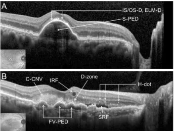 Fig. 2. Inner and outer segment junction (IS/OS) and external  limiting membrane (ELM) line lengths in spectral domain  opti-cal coherence tomography (SD-OCT)