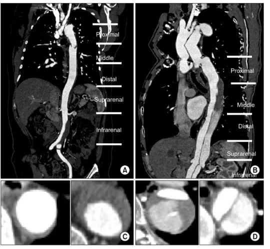 Fig. 1. The conditions of false lu- lu-men were evaluated in the horizontal  plane at five levels of the proximal,  middle and distal 1/3 descending  thoracic aorta and suprarenal and  in-frarenal abdominal aorta