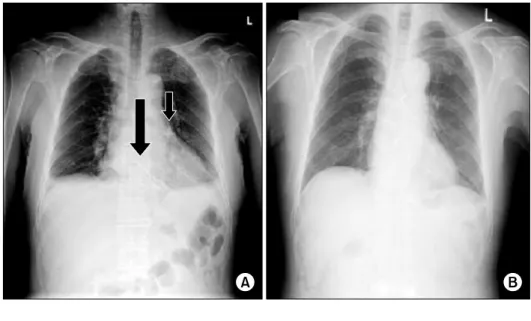 Fig. 1. (A) Initial chest roentgeno- roentgeno-gram showing the foreign bodies  (ar-rows)