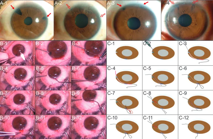 Fig. 1. Figures (A) presented preoperative and postoperative photographs of cases (case 1, A-1 and A-2; case 2, A-3 and A-4)