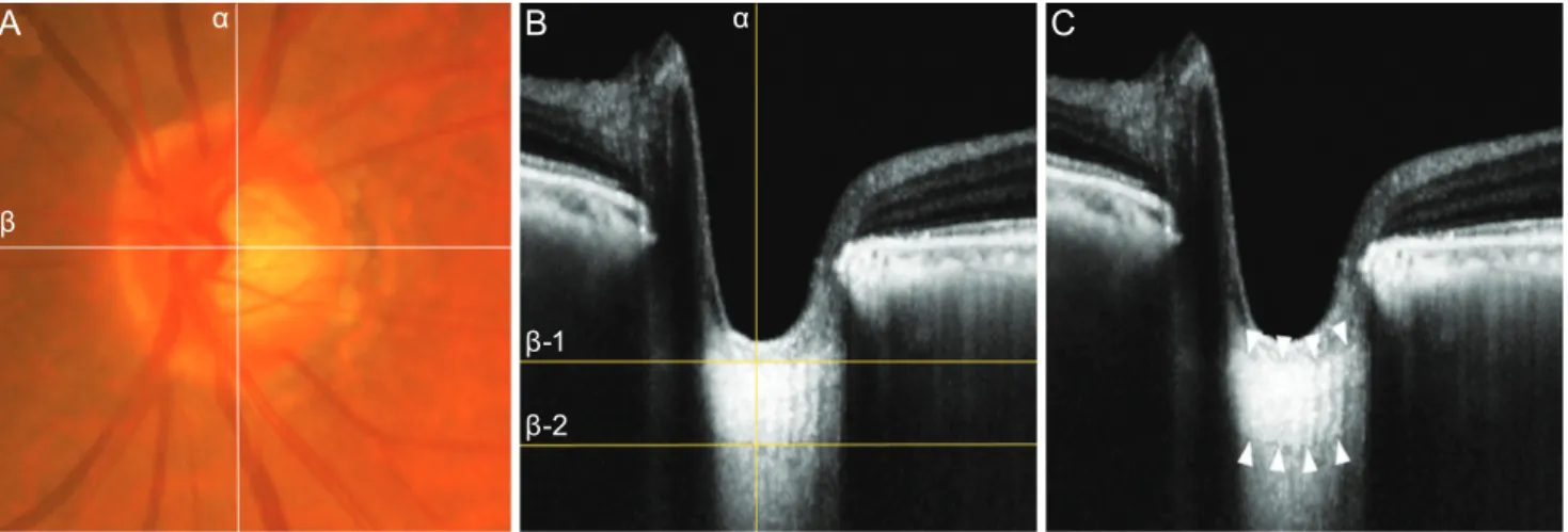 Fig. 1. (A) Fundus photograph and (B,C) spectral-domain optical coherence tomography (OCT) images in the enhanced depth imaging  (EDI) mode in a 78-year-old woman with normal-tension glaucoma