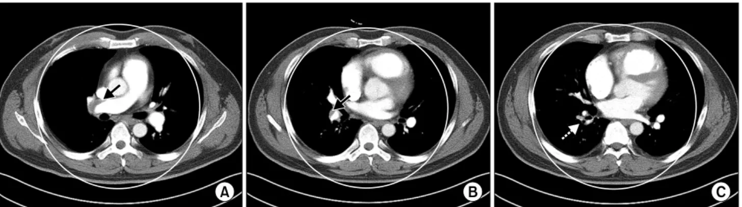 Fig. 1. Chest computed tomography (CT) angiogram shows thrombus (arrow) in the right pulmonary artery (A) and the right lower pulmo- pulmo-nary artery (B)