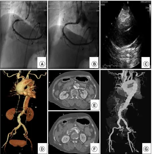Fig. 1. Angiography, echocardiogra- echocardiogra-phy, and computed tomography (CT). 