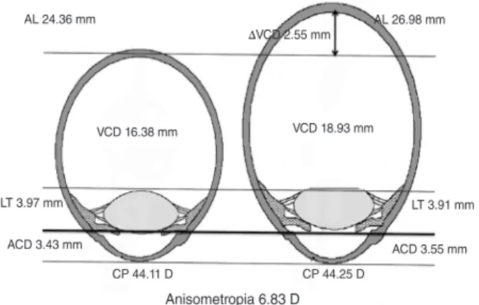 Fig. 3. A comparison of ocular components between the smaller  eye and the larger eye in anisometropia group 6